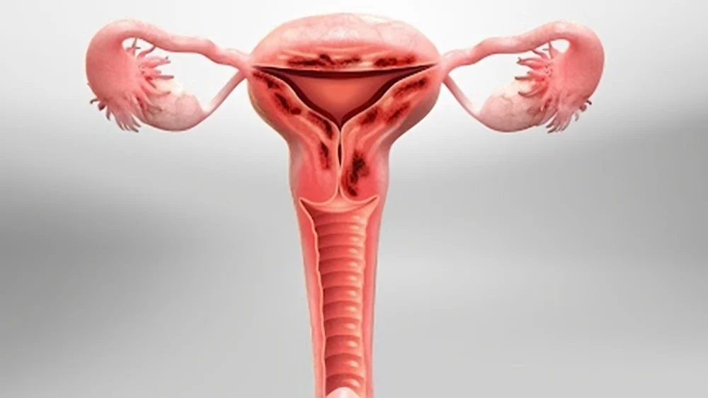 Combining HIFU and Pharmacotherapy Shows Promise for Adenomyosis-Related Infertility – EJOG