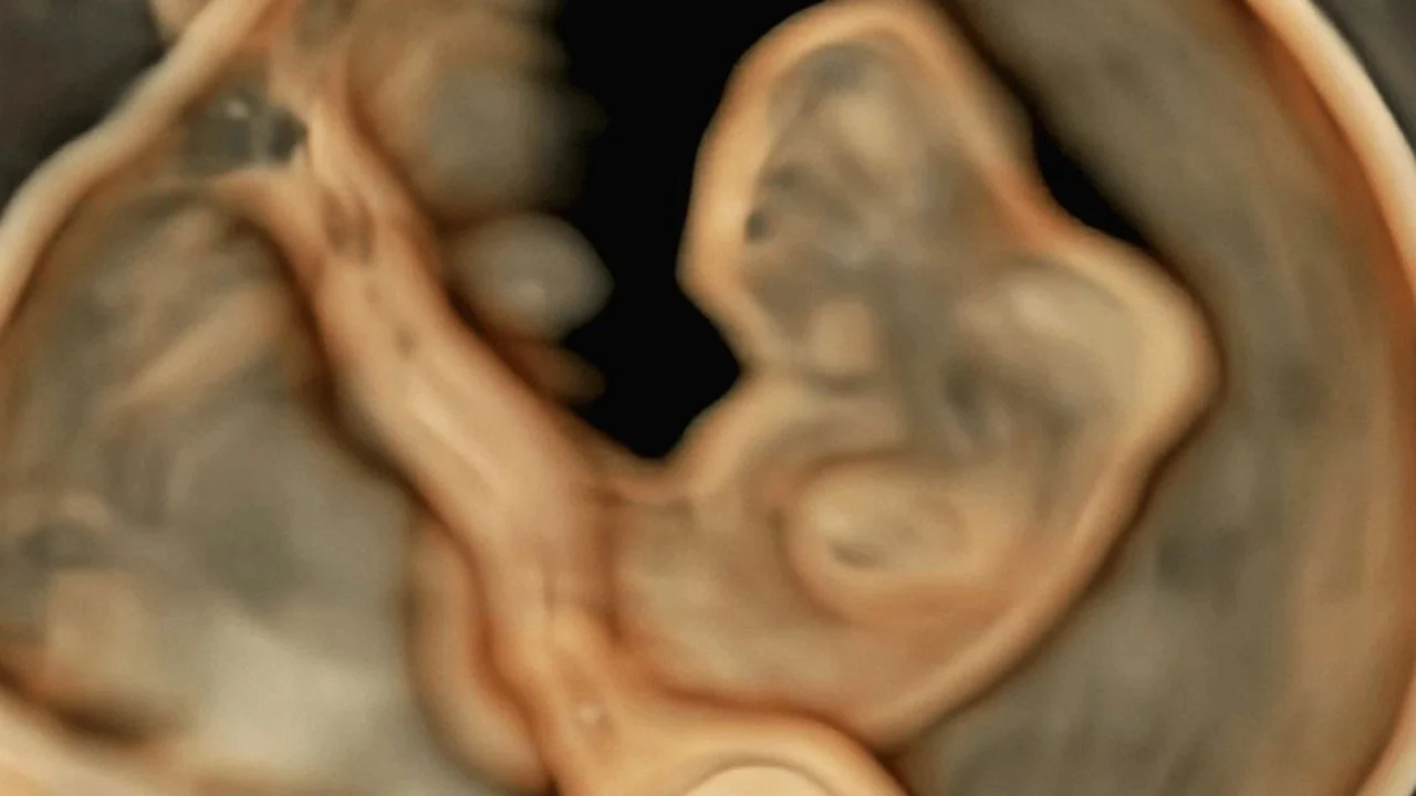 Early Diagnosis of Fetal Acrania – ISUOG