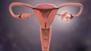 Metabolomics Uncovers Biomarkers for PCOS Diagnosis and Therapy - JMSACL