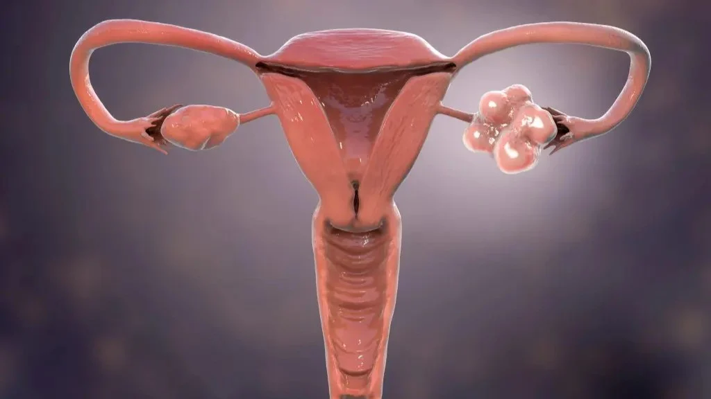 Metabolomics Uncovers Biomarkers for PCOS Diagnosis and Therapy – JMSACL