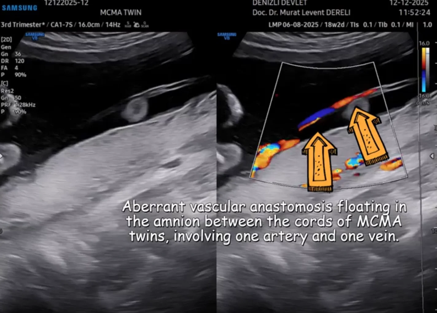 Murat Levent Dereli: Monochorionic-Monoamniotic Twin with Aberrant Vascular Anastomosis