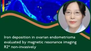 Exploring Iron Deposition in Ovarian Endometriomas - RBMO