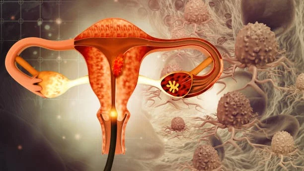 Endometriosis Care: Bridging Gaps in Australian Primary Health – Women’s Reproductive Health