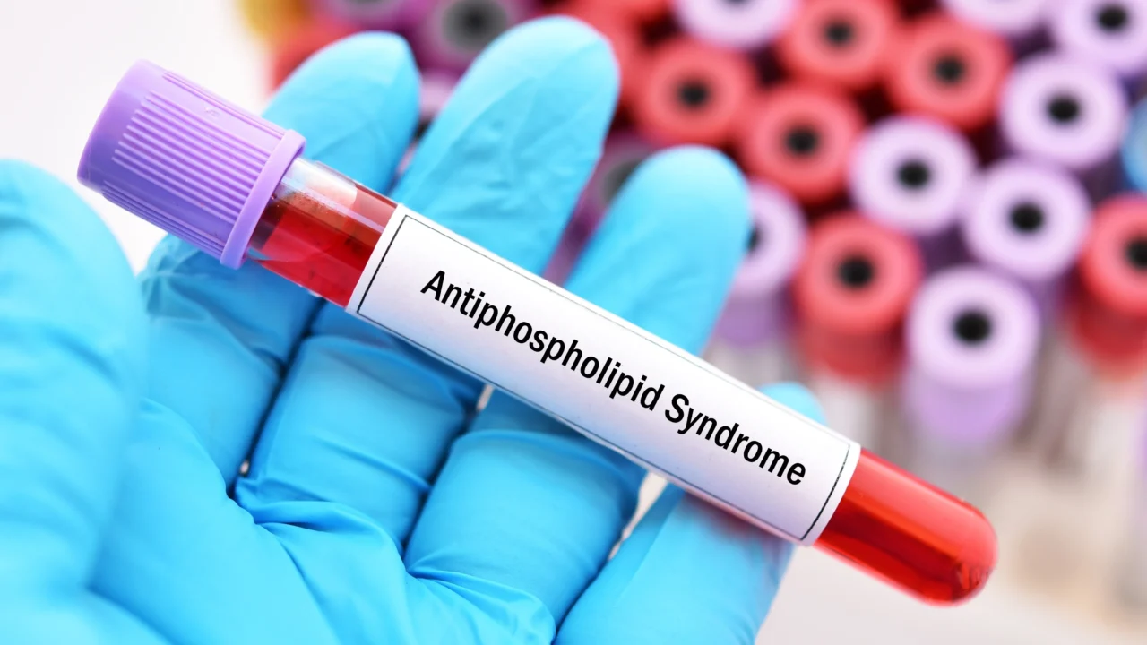 Predictors of Mortality in Antiphospholipid Syndrome Patients – HSS Education Institute