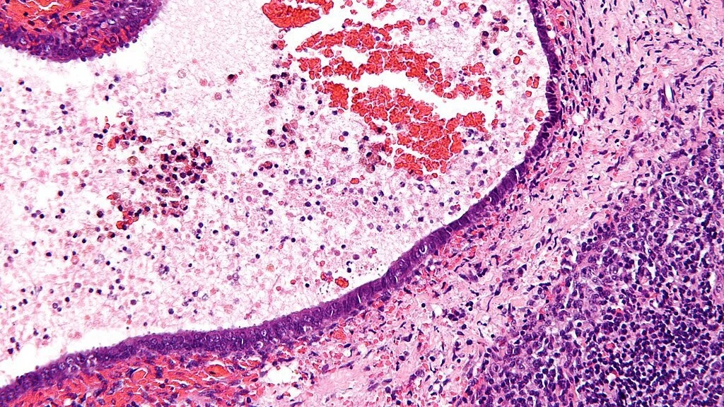 Ananda Pharma Cleared to Launch Phase 2 Trial for Endometriosis Pain Treatment – Cannabis Health