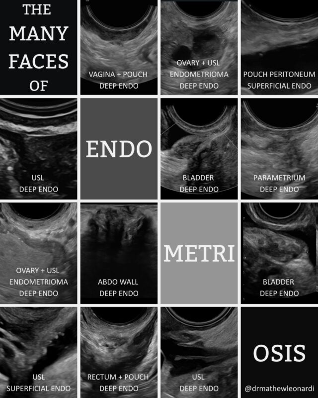 Mathew Leonardi: Why Endometriosis Is Often Missed?