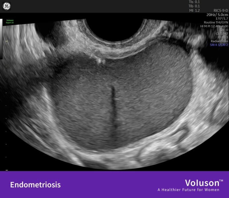 Adenomyosis vs Endometriosis: Similar Symptoms, Different Diagnoses! – GE HealthCare Voluson Ultrasound