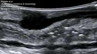 The Role of Intraoperative Ultrasound in Deep Endometriosis Management - ISUOG