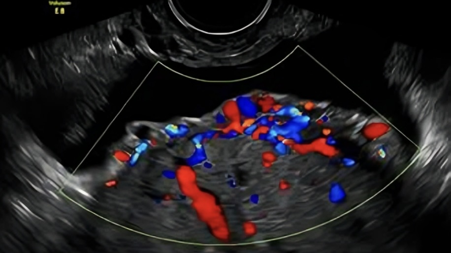 Placenta Previa or PAS? Test Your Diagnostic Skills – ISUOG