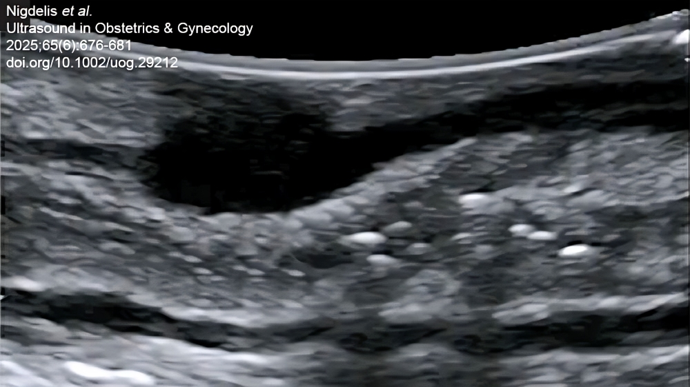 The Role of Intraoperative Ultrasound in Deep Endometriosis Management – ISUOG
