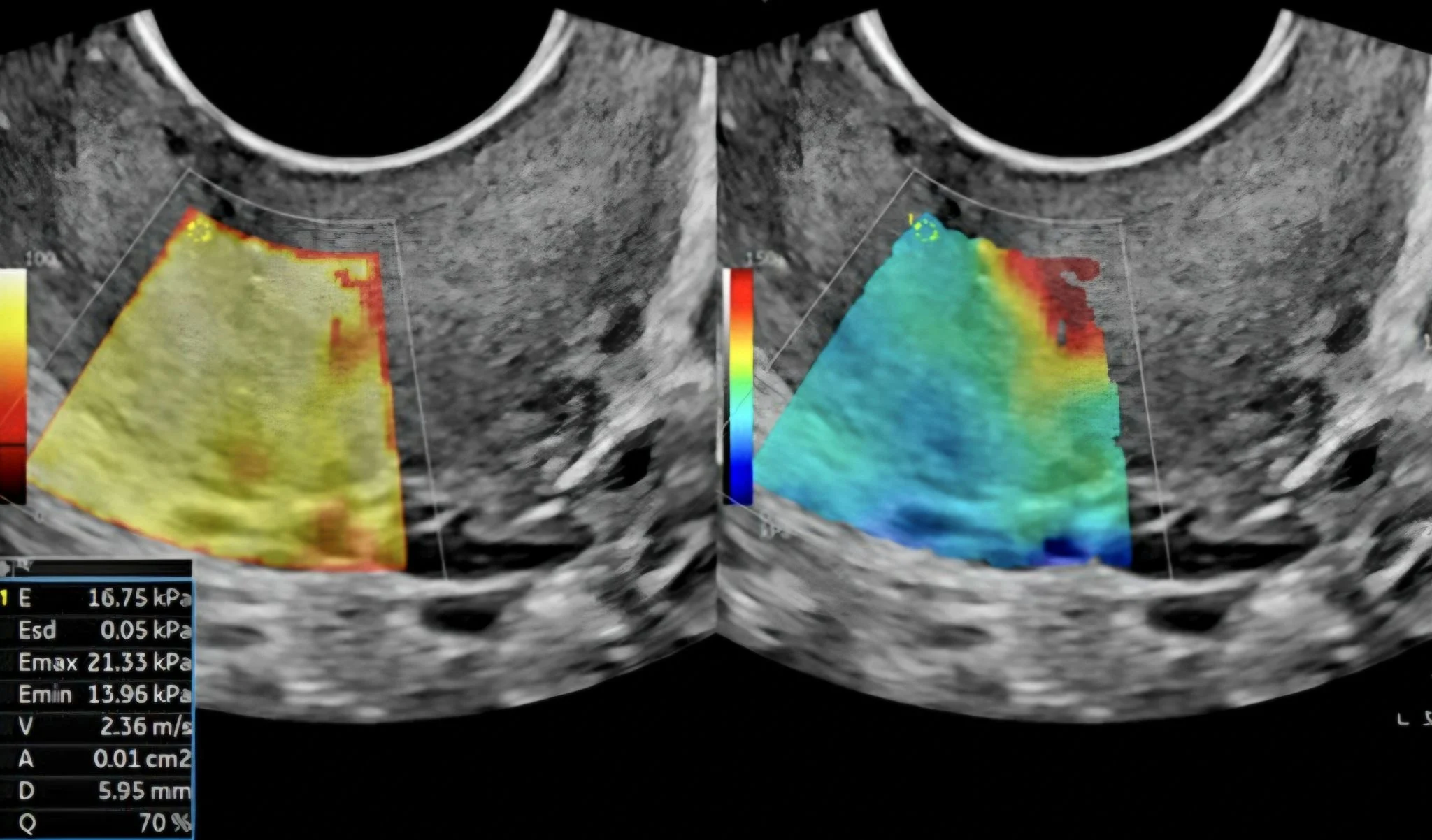 Marco Zaccaria: Internal Cervical Os Stiffness as Key Marker in Adenomyosis