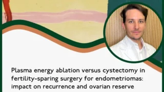Plasma Energy Ablation vs. Laparoscopic Cystectomy in Unilateral Ovarian Endometrioma - RBMO