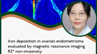 Does Surgery Reduce Iron Deposition in Ovarian Endometriomas? - RBMO