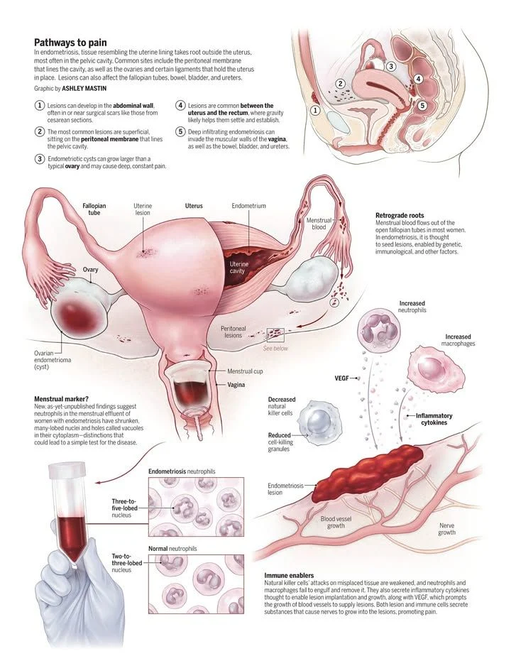 Uncovering the Role of the Immune System in Endometriosis – Science Magazine