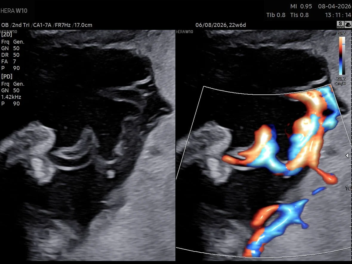 Mahmoud Moussa: PCI in MC Twins Can Give False Reassurance Despite Higher Risk