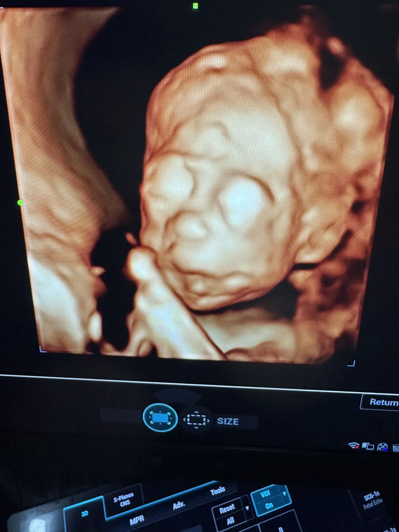 Reem Prince: Fetal Anomaly Case on Semilobar Holoprosencephaly