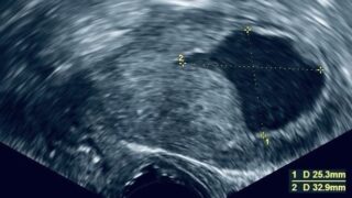 The Impact of Endometrial Fluid on Single Euploid Frozen Embryo Transfers - ReproScientifics - SpermTracer