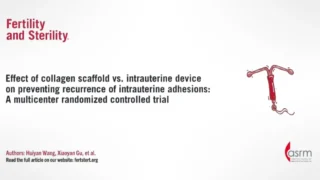 Effect of Collagen Scaffold Vs. IUD on Preventing Recurrence of Intrauterine Adhesions - Fertility and Sterility
