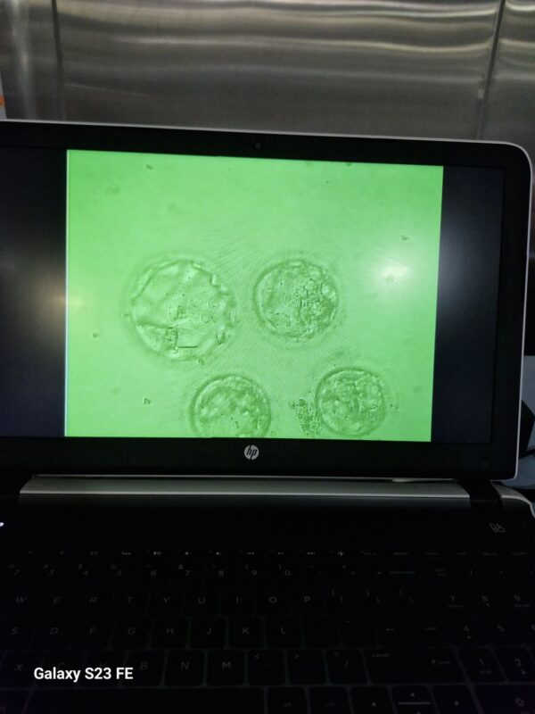 Silpi Saikia: Not Every Successful Blastocyst Comes From an Easy Case!