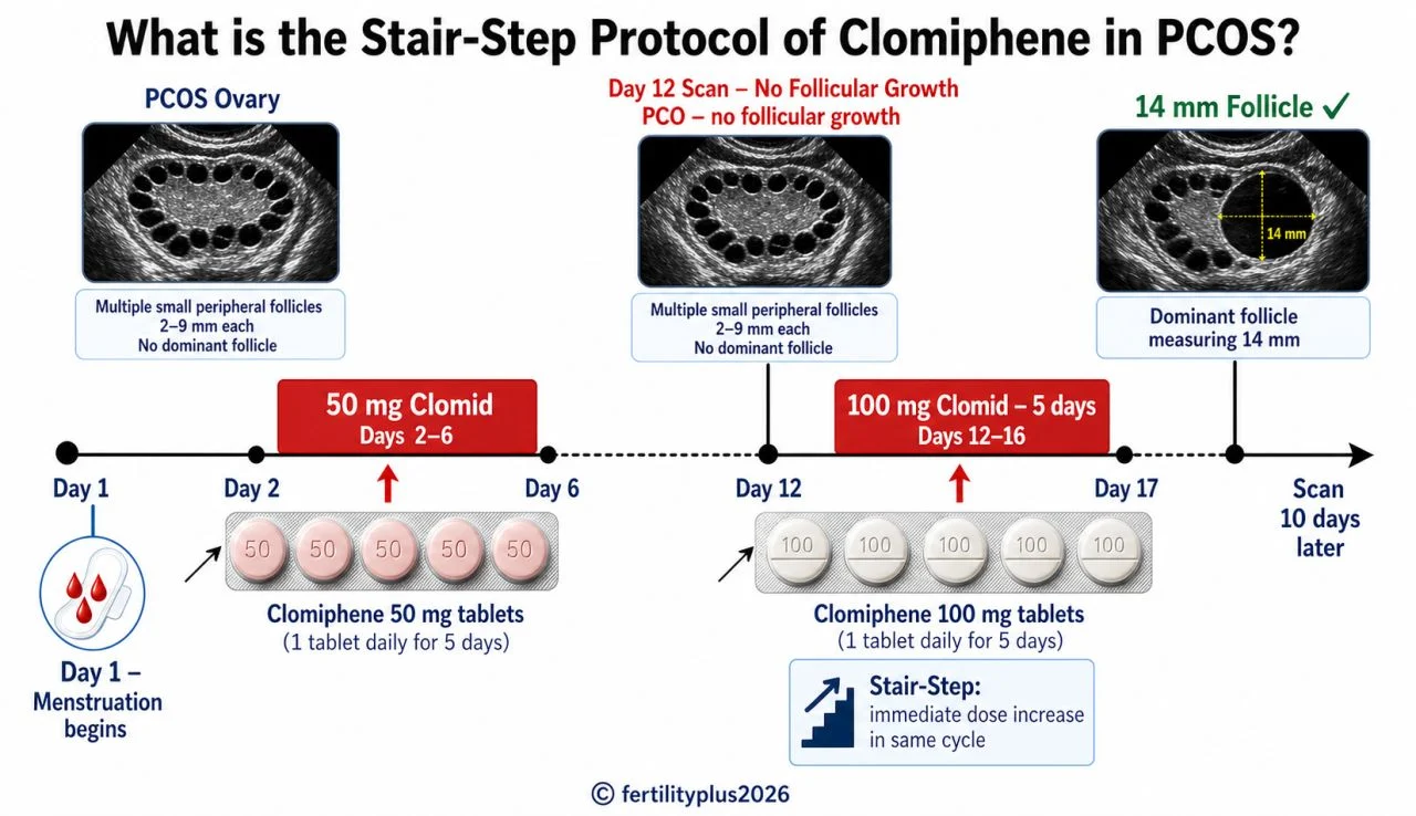 Stair-Step Protocol for PCOS Patients Who Do Not Respond to Clomid – Fertility Plus