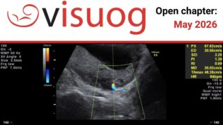 Discover the Power of Early Screening This Pre-Eclampsia Awareness Month - ISUOG