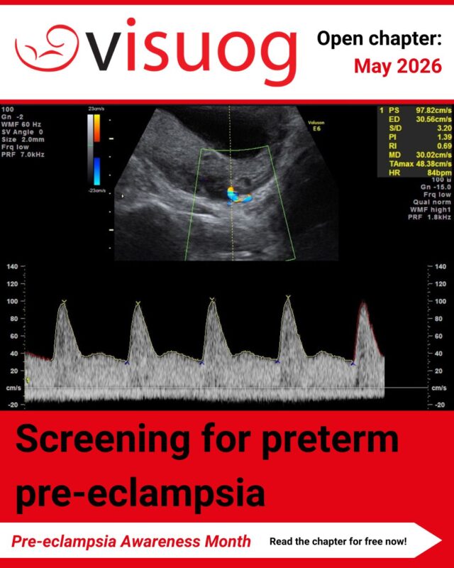Discover the Power of Early Screening This Pre-Eclampsia Awareness Month – ISUOG