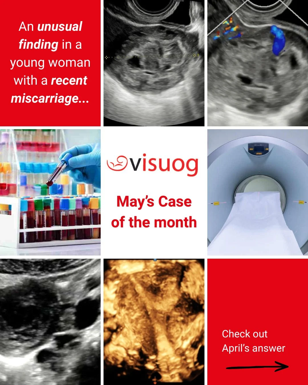 Have a Go at the May Case of the Month from VISUOG – ISUOG