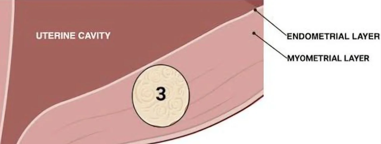 Marco Zaccaria: The “Ghost” Fibroid That Can Disappear During Hysteroscopy