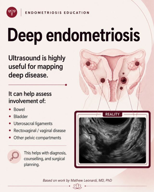 Mathew Leonardi: The Conversation Cannot Stop at Suspected Endometriosis
