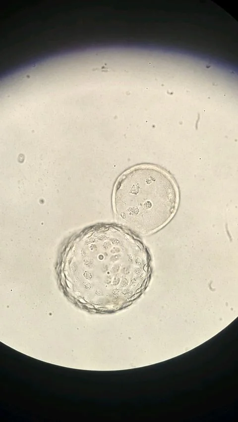 Mohammad Ismail: Successful Warming and Transfer of a Day 5 Vitrified Embryo