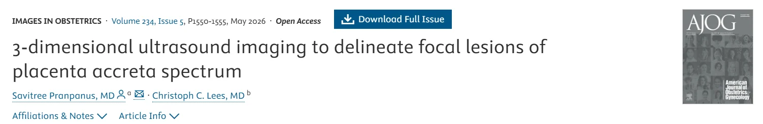 Christopher Robinson: 3D Ultrasound for Delineating Focal Placenta Accreta Spectrum Lesions