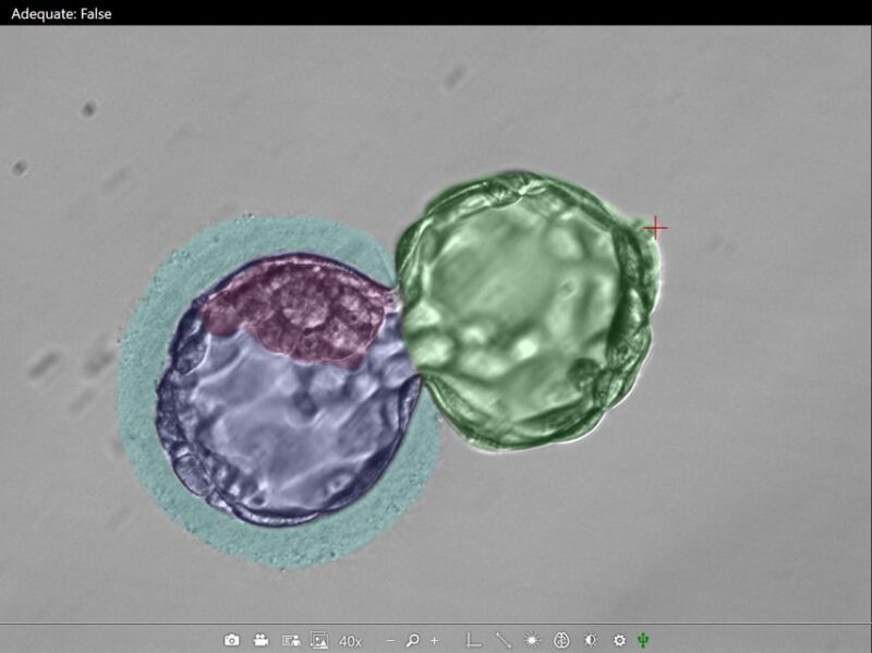 Tony Gordon: How Many Cells are There in an Embryo Biopsy?