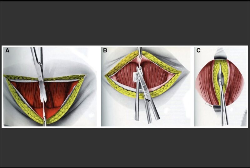 The Pelosi cesarean delivery technique - Pfannenstiel incision