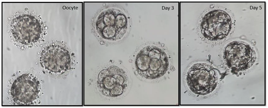 Fereshteh Safian: A Case From the IVF Lab On Dysmorphic Oocytes and Embryo Development