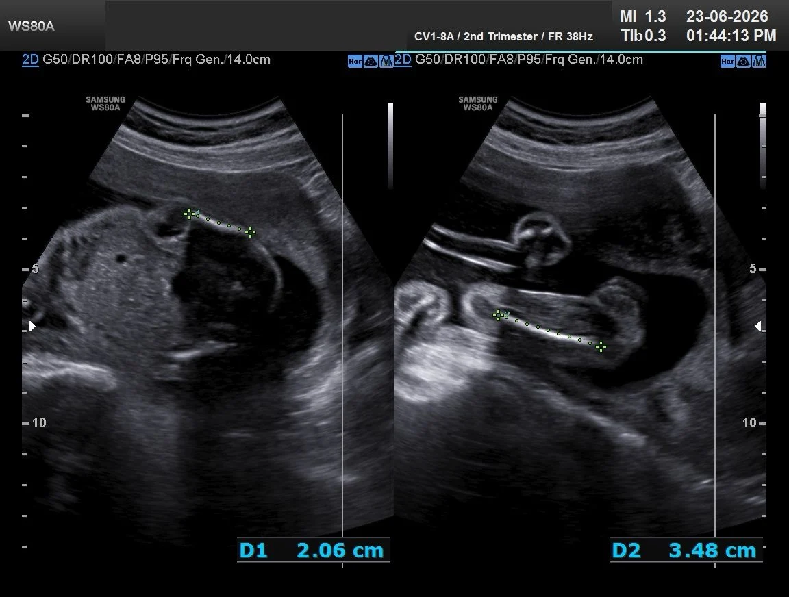 Reem Prince: Marked Unilateral Femoral Shortening Seen at 22 Weeks of Gestation
