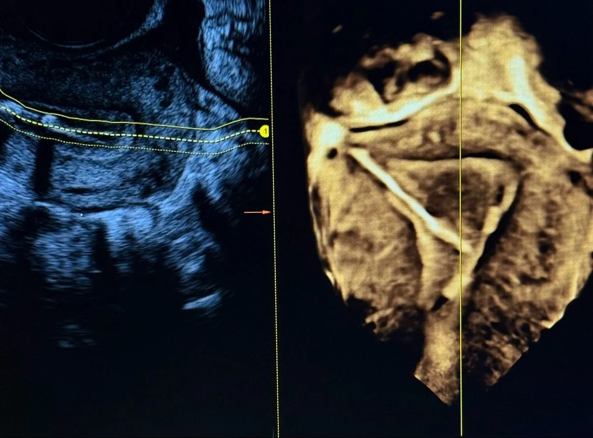 Maha Alasiri: A Case of Complete Uterine Perforation Caused by an IUD