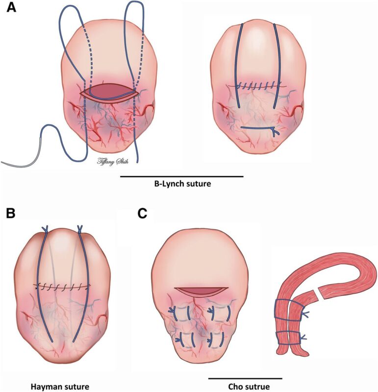 Christopher Robinson: The Nausicaä Suture in the Management of the Placenta Accreta Spectrum