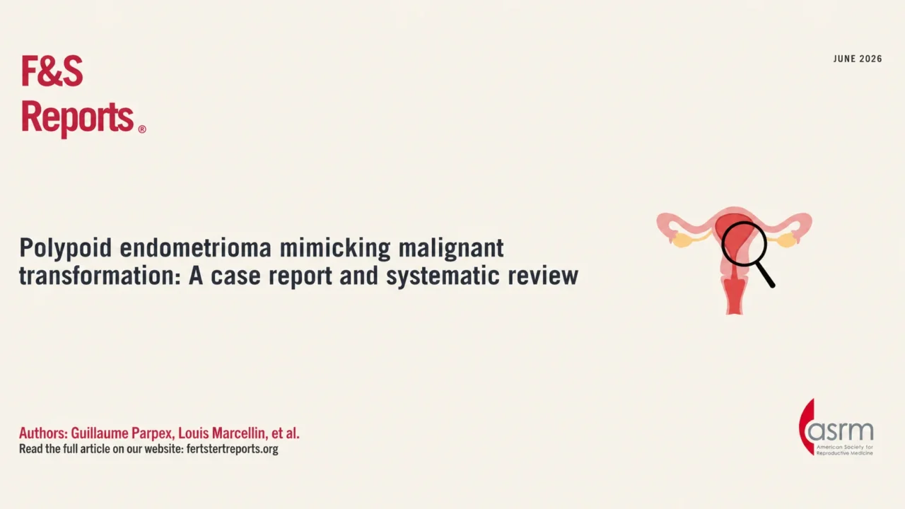 Polypoid Endometrioma Mimicking Malignant Transformation – Fertility and Sterility