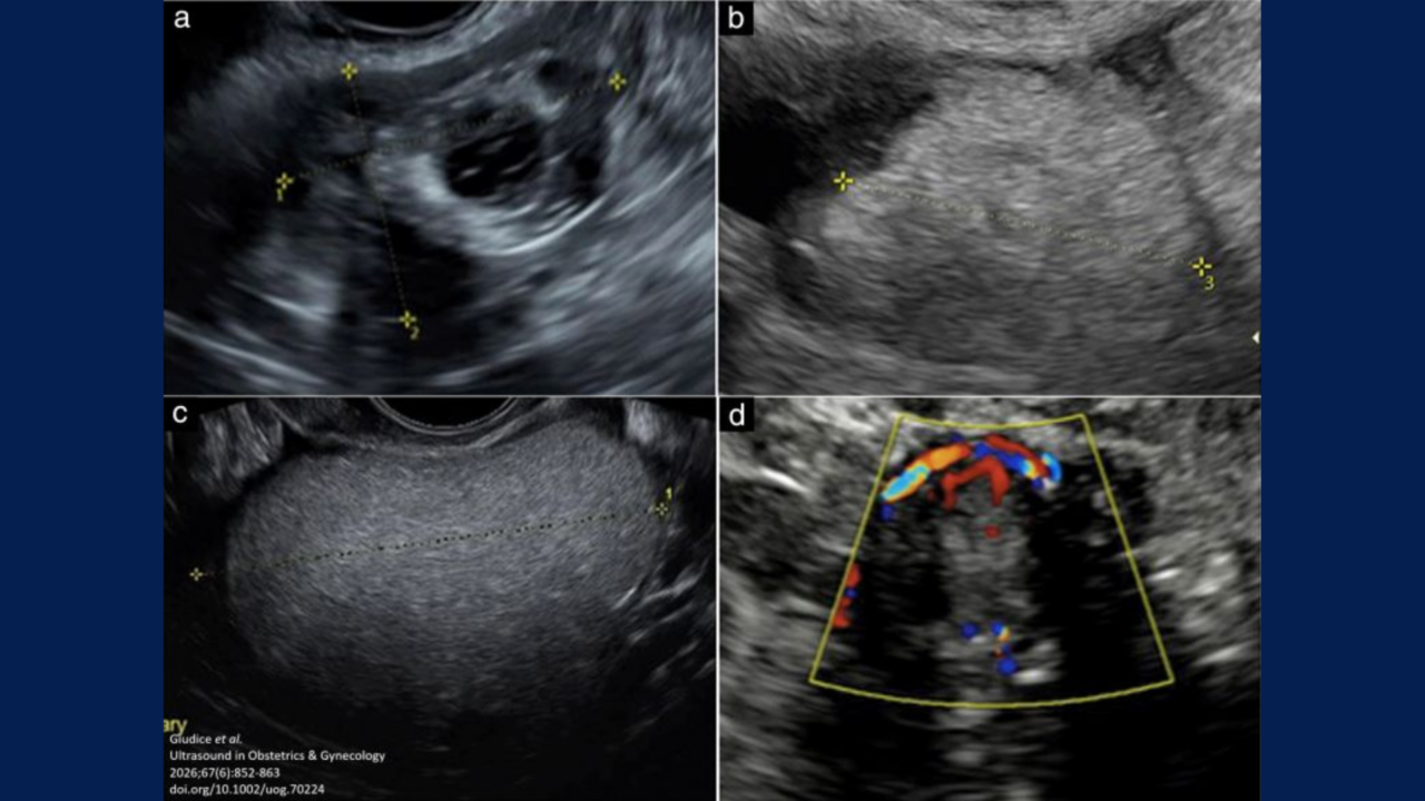 Ultrasound Features of Ovarian Mature Cystic Teratomas with Malignancy – ISUOG