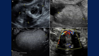 Ultrasound Features of Ovarian Mature Cystic Teratomas with Malignancy - ISUOG