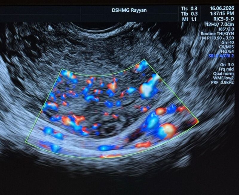 Maha Alasiri: Early Diagnosis of Interstitial Ectopic Pregnancy
