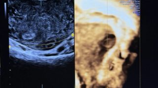 Maha Alasiri: Early Diagnosis of Interstitial Ectopic Pregnancy