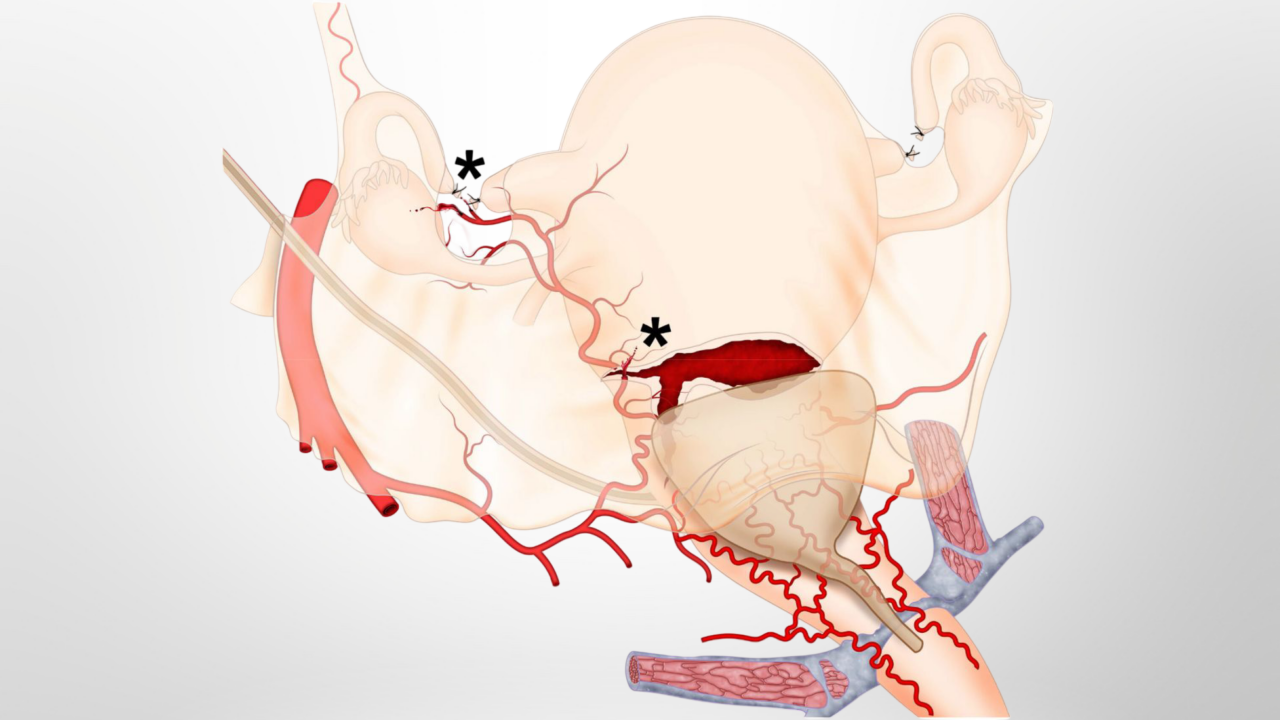Surgical Approach to Reduce the Risks of Intraoperative Complications and Postpartum Hemorrhage – IJGO