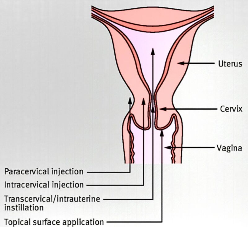 Marco Zaccaria: Intrauterine Lidocaine for Pain Management During Outpatient Hysteroscopy