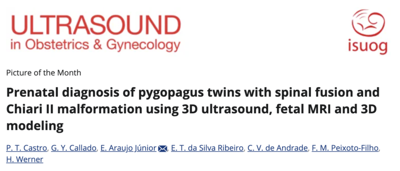 Prenatal Diagnosis of Pygopagus Twins with Spinal Fusion and Chiari II malformation – ISUOG