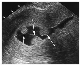 Awais Hamza: Endometrial Polyps on Ultrasound, Diagnosis and Clinical Relevance