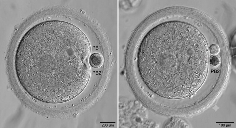 Esther Eleboh: Can Seeing Polar Bodies Predict a Good Blastocyst?