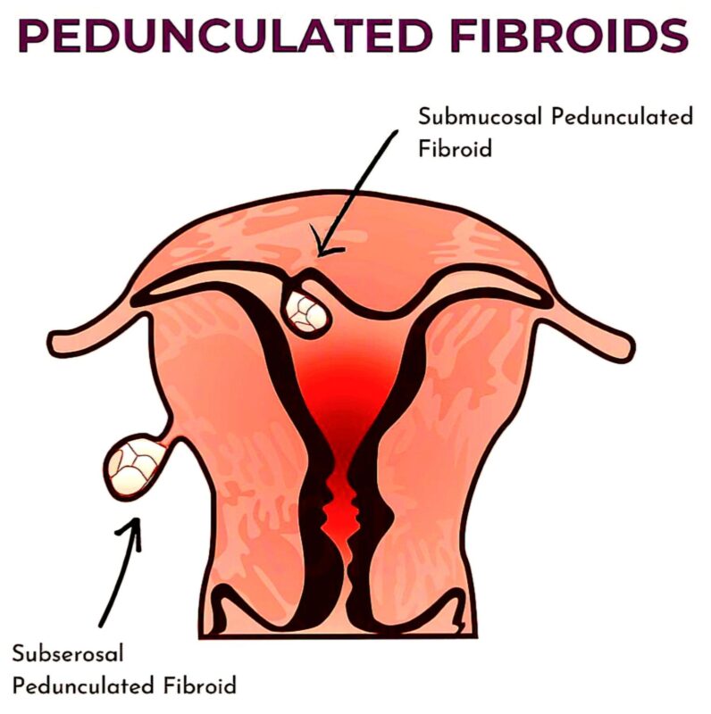 Marco Zaccaria: When a Uterine Fibroid Twists, Recognizing a Surgical Emergency!