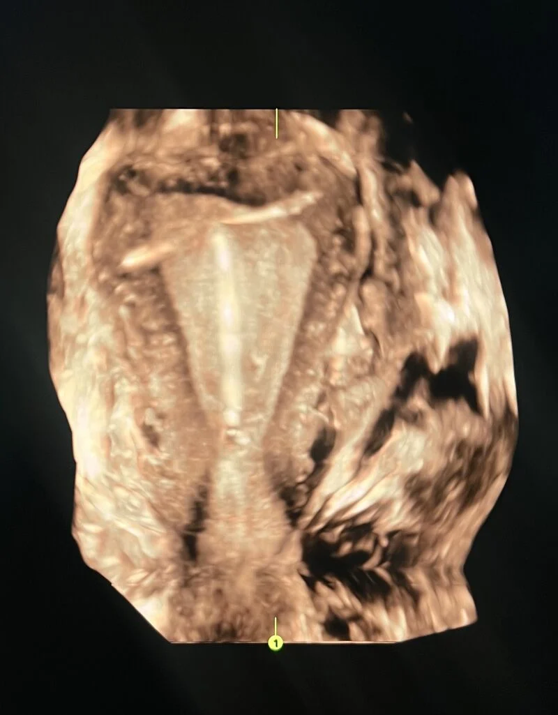 Rebecca Durante: Correct IUD Assessment Requires Evaluation of Both the Stem and Transverse Arms