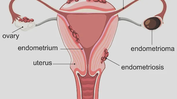 Marie-Blanche Tchetgen: It’s Not Always a UTI, The Bladder Side of Endometriosis!